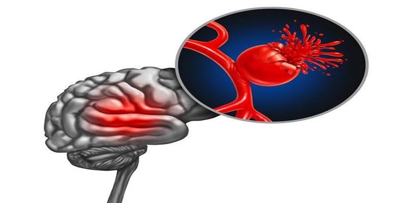 Advanced Methods for Treating Brain Aneurysms Safely