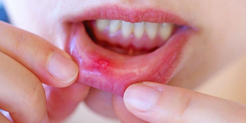 Health Risks: Why You Should Never Ignore That Mouth Sore That Won’t Go Away